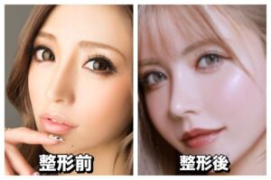 一条響の整形前は？顔変わりすぎって変わった箇所はどこ？