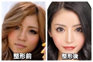 一条響の整形前は？顔変わりすぎって変わった箇所はどこ？